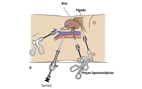 Clínica Uroderm, Nefrectomia Parcial ou Radical Videolaparoscópica em Montes Claros, MG
