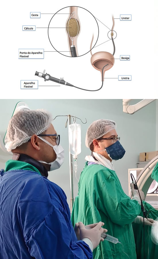 Clínica Uroderm, Ureterorrenolitotripsia Flexível a Laser em Montes Claros, MG