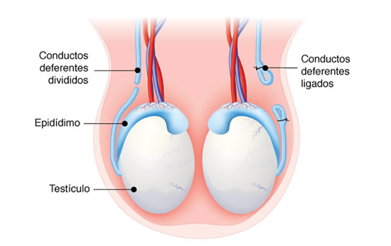 Clínica Uroderm, Cirurgia de Vasectomia em Montes Claros, MG